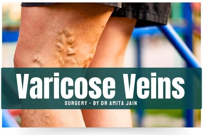 varicose vein doctor and surgeon Dr Amita Jain